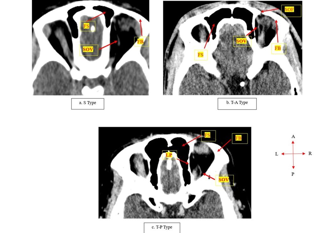 Fig. 1: Axial CT images showing the different morphological patterns of the superior ophthalmic vein; S Type – straight from proximal to distal; Type T-A – tortuous anteriorly (distally); and Type T-P – tortuous posteriorly (proximally) (images by Cele et al., 2026).