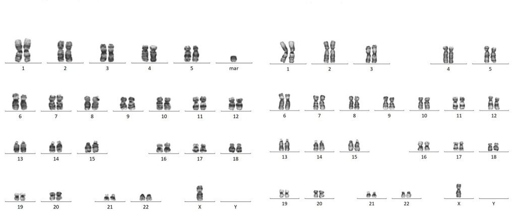 Fig. 1: Karyotype of case1- 46,XO,+mar/ 45,XO.