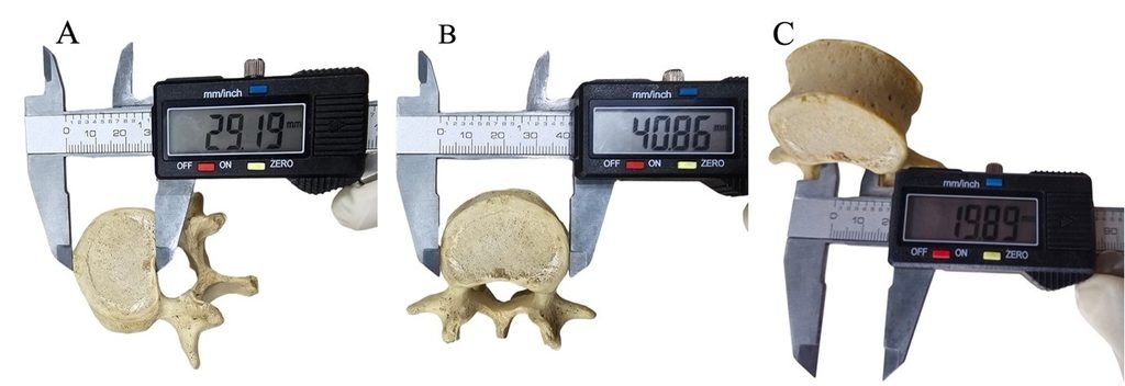 Fig.1: Direct osteometric measurement of a dry human lumbar vertebra using a digital Vernier calliper. (A) Measurement of the mid-sagittal anteroposterior (AP) diameter of the vertebral body at the superior level (B). Measurement of the transverse diameter (width) of the vertebral body at the superior level (C). Measurement of the transverse diameter of the vertebral canal.