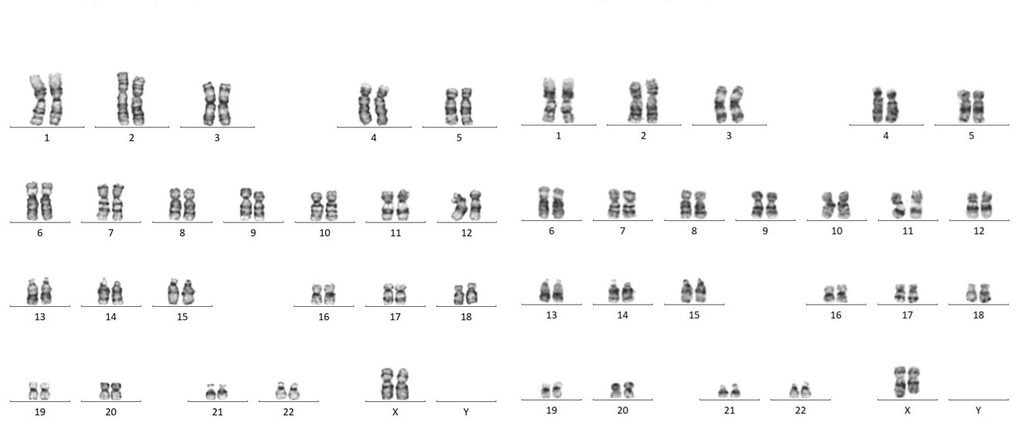 Fig. 2: Karyotype of case 2-46,XX/46,XX,del(X)(q26).