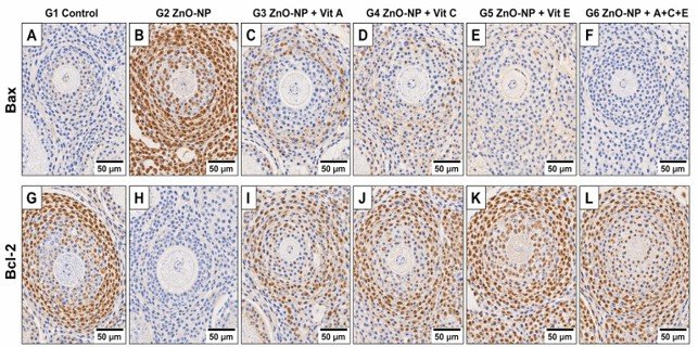 Fig. 2: Immunohistochemical expression of Bax (upper panels, A–F) and Bcl-2 (lower panels, G–L) in ovarian granulosa cells (DAB chromogen/haematoxylin counterstain, ×200). Brown = DAB-positive (protein expressed); blue = haematoxylin counterstain. In G2 (B, H), Bax is strongly and diffusely expressed while Bcl-2 is markedly reduced. Progressive restoration of the Bax-low/Bcl-2-high pattern is evident from G3 to G5, with near-complete reversal in G6 (F, L). Scale bar = 50 µm.