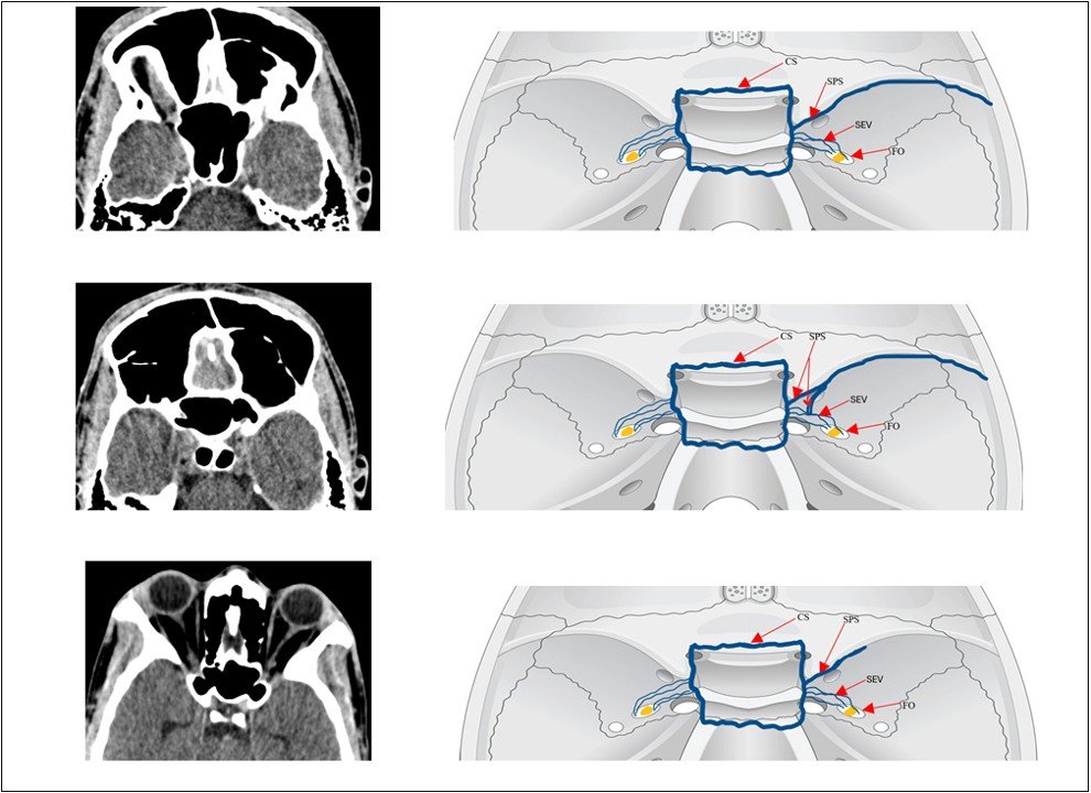 Fig. 3: Axial CT images illustrating the different drainage patterns of the sphenoparietal sinus; Type A – drained into the lateral aspect of the cavernous sinus; Type B – it connected to the cavernous sinus and the sphenoid emissary veins; Type C – is hypoplastic (images by Cele et al., 2026).