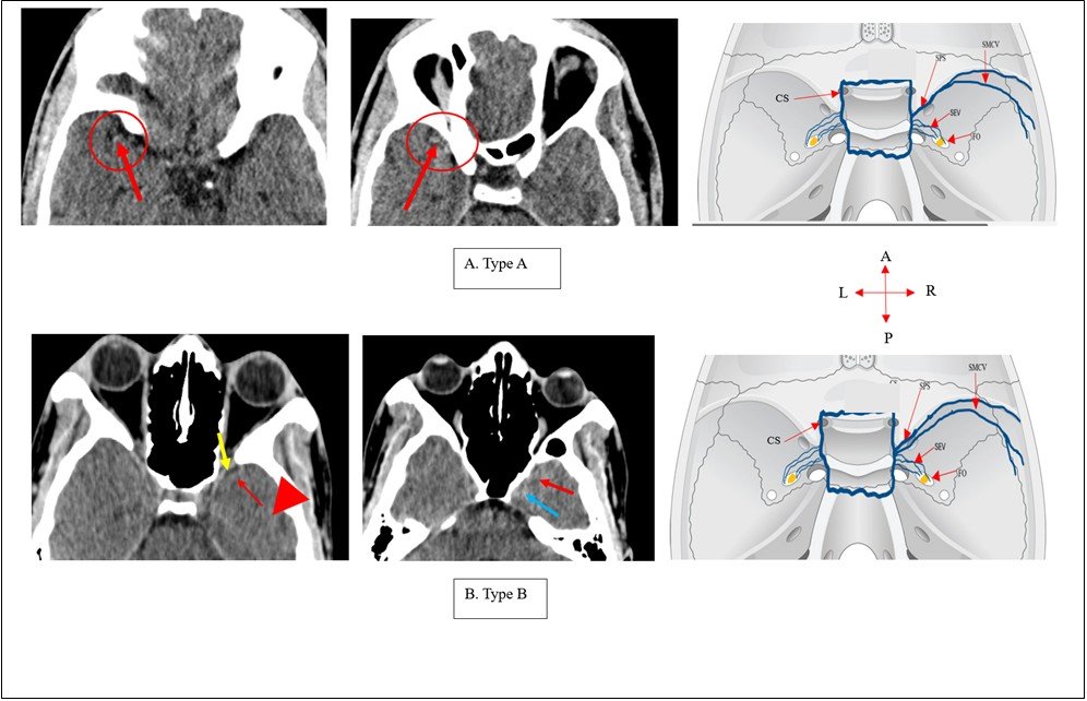Fig. 4: Axial CT images illustrating the different drainage patterns of the superficial middle cerebral vein: Type A – the superficial middle cerebral vein drained into the sphenoparietal sinus; Type B – it drained into the lateral aspect of the cavernous sinus; Type C – it connected to the sphenoid emissary veins draining into the pterygoid plexus of veins; and Type D – it drained into the superior petrosal sinus and the transverse/sigmoid sinus (images by Cele et al., 2026).