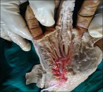 Fig. 4: Complete SPA formed by the ulnar artery only.
