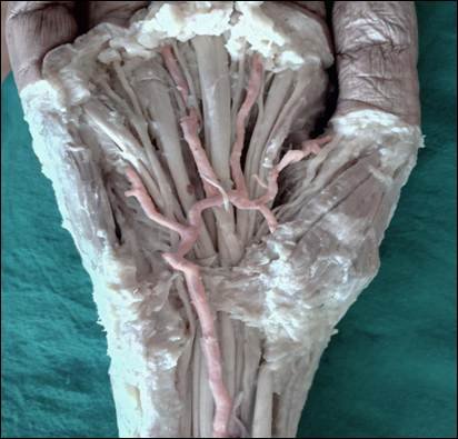Fig. 3: Complete SPA formed by the union of radial and ulnar arteries.