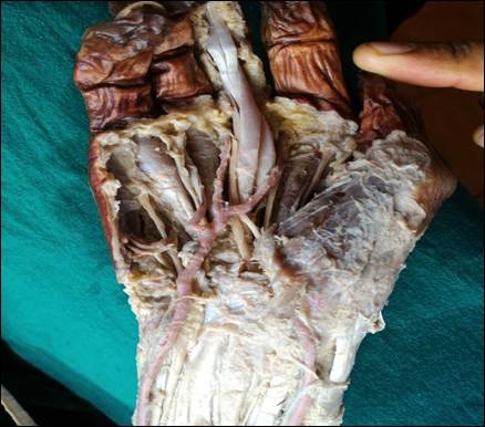 Fig. 5: Incomplete SPA formed by the radial and ulnar arteries.