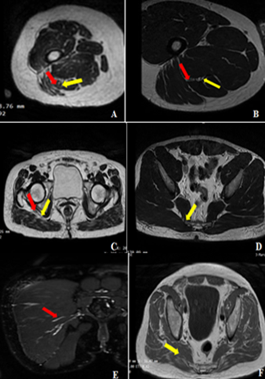 Fig. 1: Axial T2- weighted MRI images demonstrating levels of sciatic nerve bifurcation (A-C) at the upper border of popliteal fossa (A), upper thigh (B), sub gluteal region(C) . The red arrows represent the common peroneal nerve while the yellow arrow demonstrate the tibial nerve. Anatomical variation of Piriformis muscle (D-F): variation I (D) with typical pear-shaped morphology(yellow arrow). Variation II (E) in which the piriformis is divided into two parts with the common fibular nerve (red arrow) coursing between them. Variation III (F) demonstrates the union of the piriformis muscle with the gluteus medius muscle (yellow arrow).