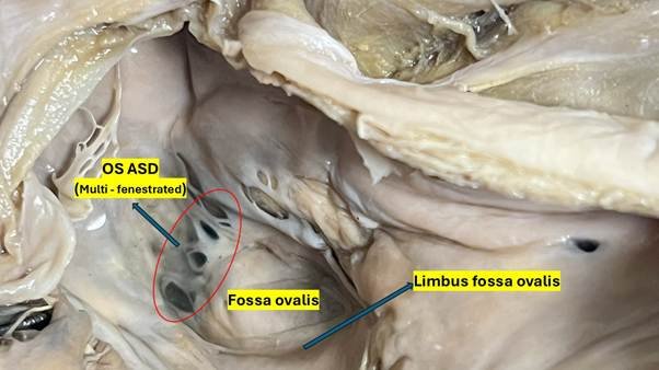 Fig. 1: Gross anatomical specimen of the right atrium illustrating a Mult fenestrated ostium secundum atrial septal defect (OS ASD). The interatrial septum is observed from the perspective of the right atrium. Numerous distinct fenestrations are evident within the fossa ovalis, indicative of a Mult fenestrated OS ASD, as highlighted in red. The next elevated muscle border limbus fossa ovalis (annulus ovalis) is well-preserved and complete.