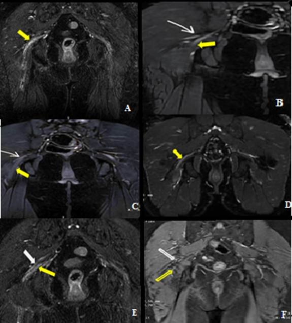 Fig. 2: Coronal T2-weighted MRI of the pelvis demonstrating the sciatic nerve–piriformis muscle relationship according to the Beaton and Anson classification. Type I (A): undivided sciatic nerve (yellow arrow) passing inferior to the piriformis muscle. Type II (B): common peroneal nerve (white arrow) passing through the piriformis muscle while the tibial nerve (yellow arrow) passes inferiorly.Type III (C): common peroneal nerve (White arrow) passing superior to the piriformis muscle with the tibial nerve (Yellow arrow) passing inferiorly.Type IV (D): undivided sciatic nerve (Yellow arrow) passing through the piriformis muscle. Type V (E): common peroneal nerve (White arrow) passing through the piriformis muscle while the tibial nerve ( Yellow arrow) passes superiorly. Type VI (F): undivided sciatic nerve (White arrow) passing superior to the piriformis muscle (Yellow arrow).