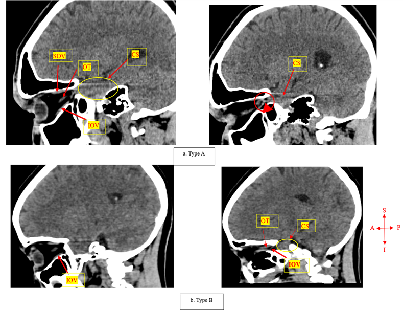 Fig. 2: Sagittal CT images showing the different drainage patterns of the inferior ophthalmic vein; Type A – drains into the superior ophthalmic vein before draining into the cavernous sinus; Type B – drained directly into the cavernous sinus bypassing the superior ophthalmic vein (images by Cele et al., 2026).